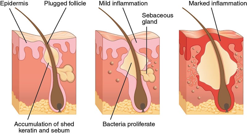 Purging vs Breakouts forming microcomedone