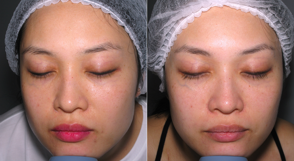 My Ultraceuticals RVR90 Skin Brightening Experience