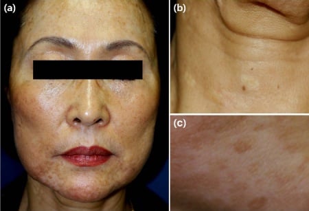 lemon juice depigmentation spots