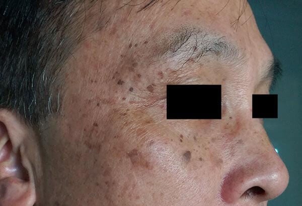 hyperpigmentation