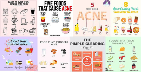 diet acne infographics