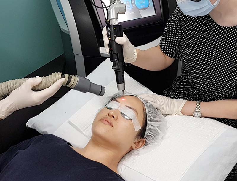 laser picosure treatment