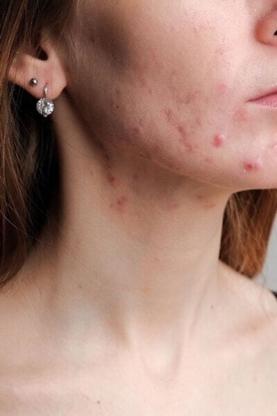 Acne breakout along jawline